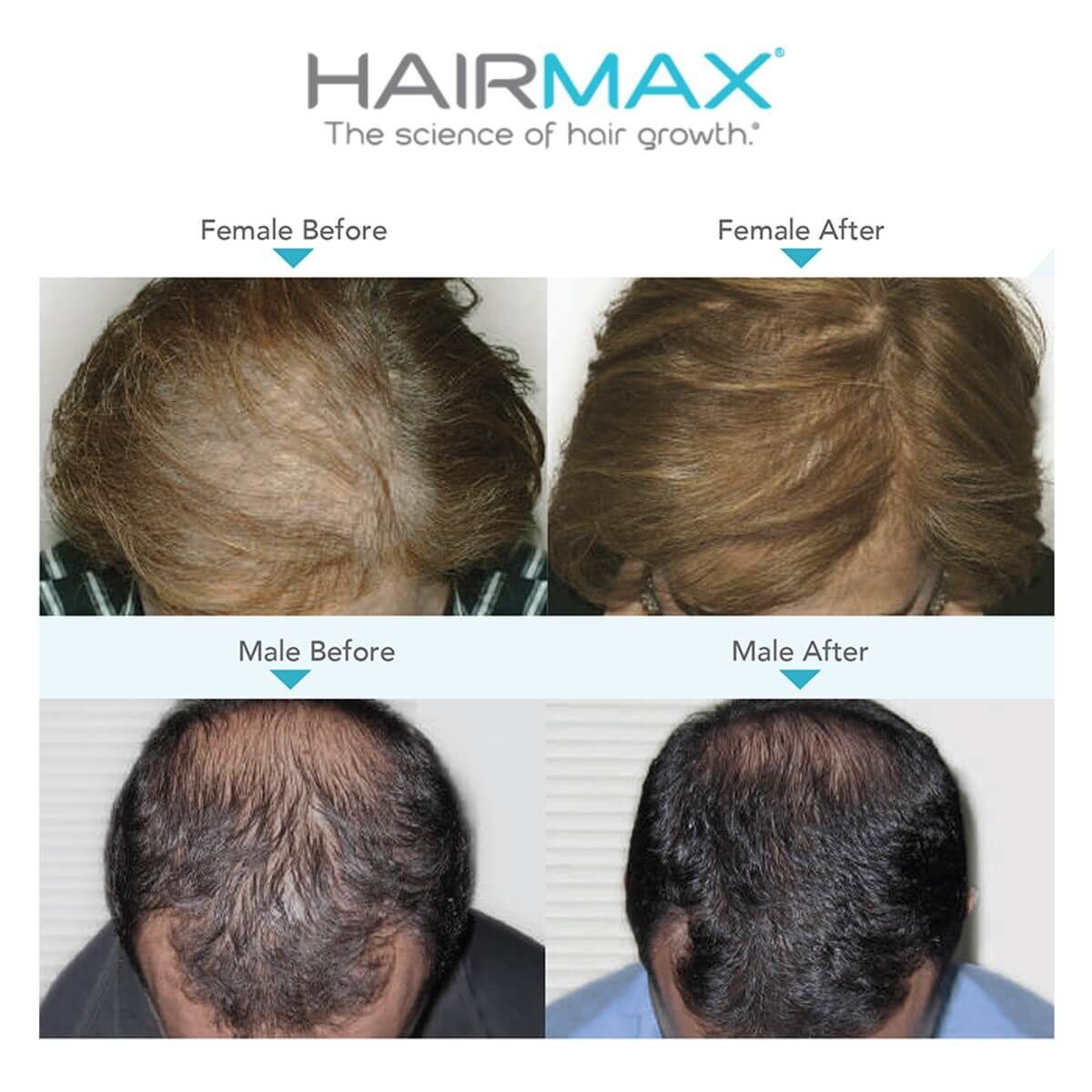 Hairmax Laserband 82