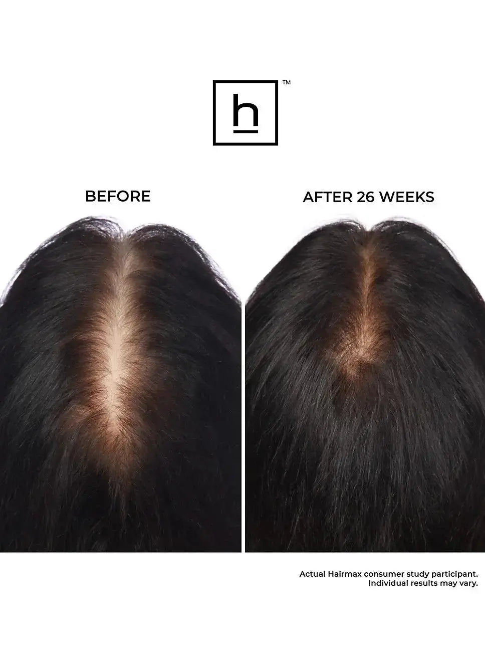 Hairmax Laserband 82 