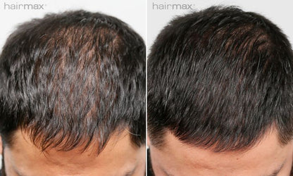 Hairmax Laserkamm Ultima 12 Classic